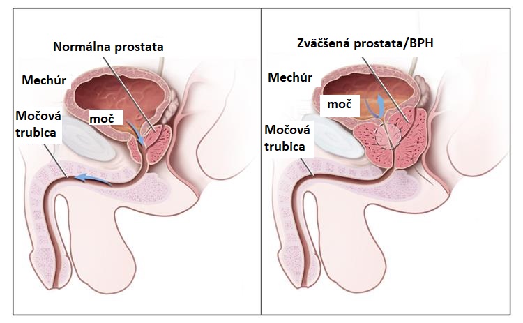 zväčšená prostata